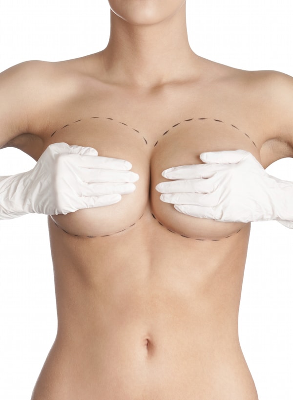 Breast Augmentation Incisions-min