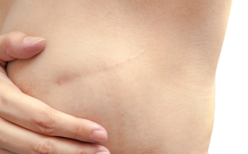Breast lift scarring types